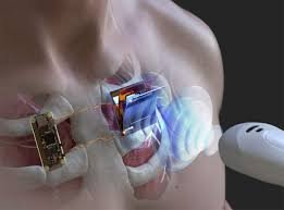 Ultrasound-based wireless charging technology for implantable medical devices