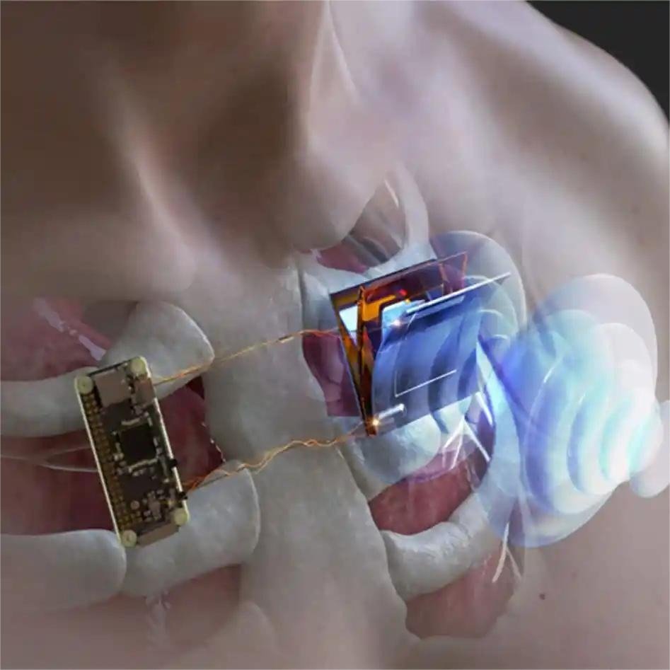 Ultrasound-based wireless charging technology for implantable medical devices